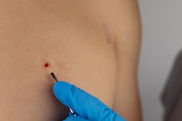 Close-up of the wound that remained after excision of the nevus. Removal and treatment of benign skin lesions. Surgery. Doctor and patient in one shot. Skin disease treatment and surgical care concept