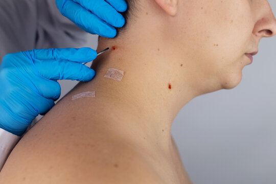 Close-up of the wound that remained after excision of the nevus. Removal and treatment of benign skin lesions. Surgery. Doctor and patient in one shot. Skin disease treatment and surgical care concept
