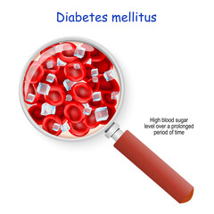 Diabetes mellitus. High blood sugar level
