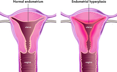 Medical illustration shows a female genital system with a normal endometrium compared with one afflicted of endometrial hyperplasia.