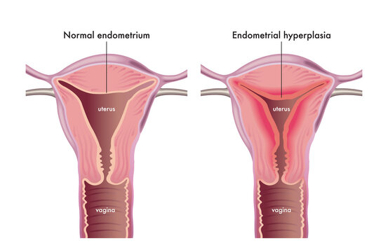 Medical illustration shows a female genital system with a normal endometrium compared with one afflicted of endometrial hyperplasia.