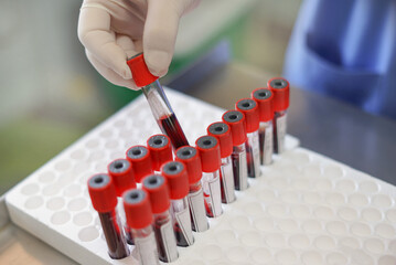 lab technician hand checking patient blood tube before submitting test, selective focus
