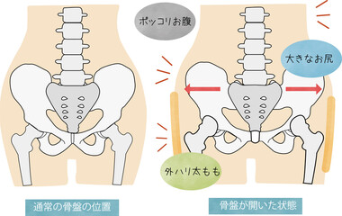 骨盤の正しい位置と開いた骨盤の骨の図解とそれによって現れる体の状態