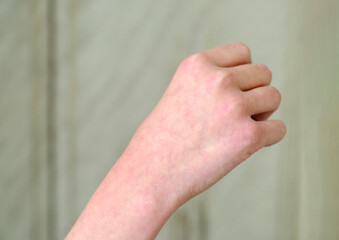 The vascular pattern is located on a person's arm or on his hand. Blood of person