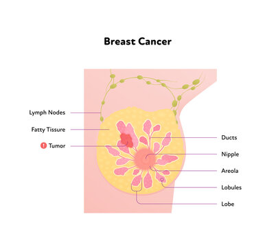 Human breast cancer anatomy diagram. Vector flat medical illustration. Front view section chart with text and tumor cell isolated on white background. Design for healthcare, science, education.