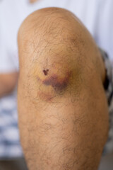 Bruises and scabs on the knee caused by extreme sports.