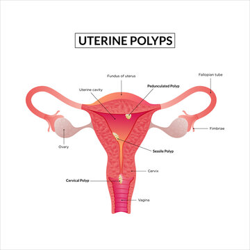 Types of Uterine Polyp. Female reproductive system diseases.