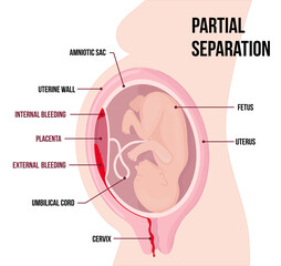 child in womb. Partial separation of placenta, placental abruption. Vaginal and internal bleeding.