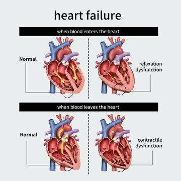 심부전 heart failure