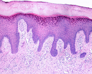 Human skin. Lichen planus. Hyperkeratosis, acanthosis and long dermal papillae 