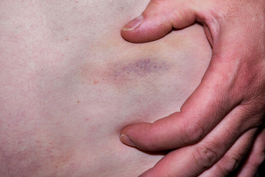 bruise on the body
