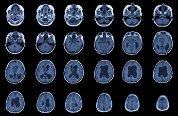 MRI Brain FINDINGS: There is a 3.5cm diameter lobulated mass at suprasellar with compression of ...