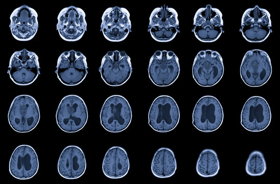MRI Brain FINDINGS: There is a 3.5cm diameter lobulated mass at suprasellar with compression of  the pituitary gland,Medical healthcare concept.