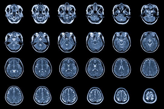 MRI Brain with and without contrast media Findings: There is a 3.5cm diameter lobulated mass at suprasellar with compression of the pituitary gland, Medical healthcare concept.