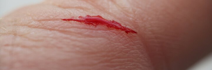 Hand of adult man with wound and blood