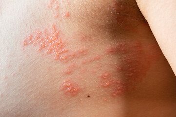 chickenpox rash. Shingles, varicella-zoster virus. skin rash and blisters on body. Skin infected Herpes zoster virus. Herpes Virus on body. urticaria rash. atopic dermatitis