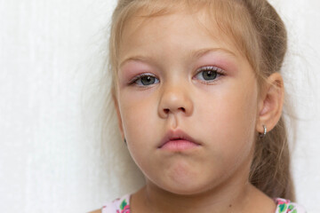 Portrait of caucasian little girl of five years old with swelling eyes because of allergy,...
