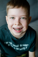 close-up portrait of a boy in braces. Correction of bite in children. The boy wears a dental plate....