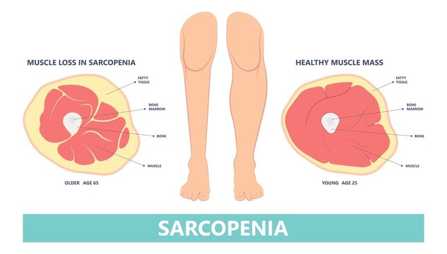 Sarcopenia Images – Browse 707 Stock Photos, Vectors, and Video | Adobe Stock