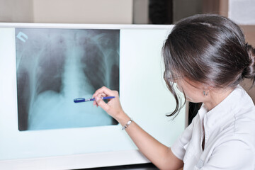doctor checking chest x-ray image of chest. young brunette woman radiologist pointing on a lung x-ray on a screen. lungs scan at radiology department in hospital.