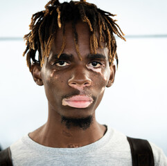 African American black young man with vitiligo skin