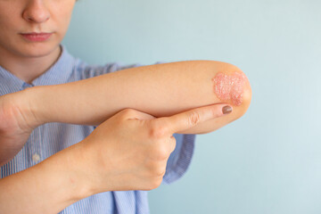 Psoriasis of a women on her elbows, sitting on the bedroom floor. Concept dermatology, skin...