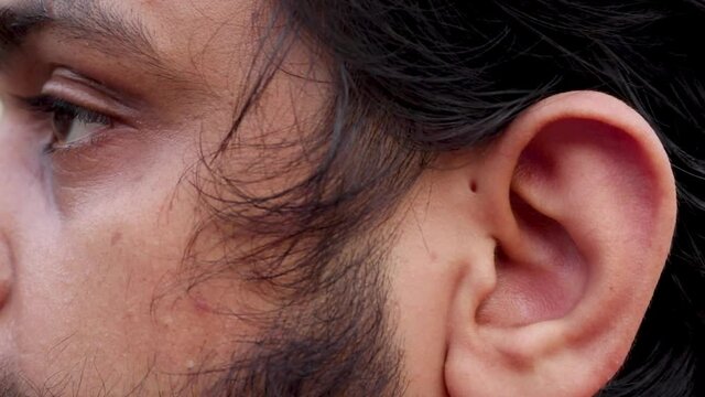 Young bearded guy with a preauricular pit near his ear. Preauricular Sinus.