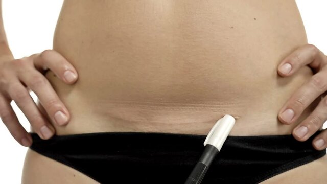 Hand of the plastic surgeon indicates the details of the operation to remove the scar on the patient's abdomen.