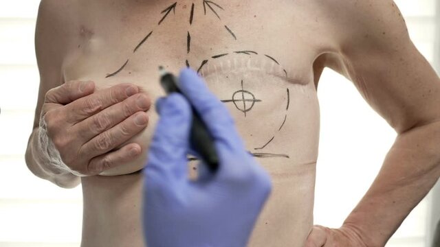 Preparing for breast reconstruction for a woman undergoing mastectomy. Breast plastic surgery after mastectomy.