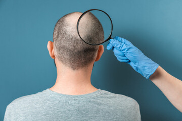 A man with alopecia on his head is being examined by a trichologist. The doctor's hand holds a...