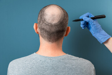 Aesthetic medicine. Doctor trichologist outlines the area of baldness on the client's head with a...