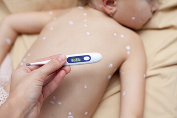 Chickenpox. Fever. A girl suffering from chickenpox lies on a bed with a thermometer. rash