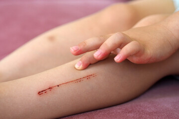 a scratch wound that forms a trace on the leg, the child's leg is injured,