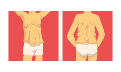 Male Torso with Sagging Belly and Soft Muscles Vector Set