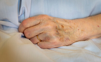 bruised hand of elderly person wearing wedding band