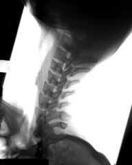 X-Ray of left hand side of the cervical spine