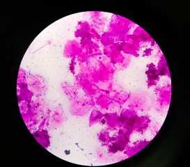 Microscopic close view of high vaginal swab Gram stain smear, 40x. diagnosis of Bacterial vaginosis...