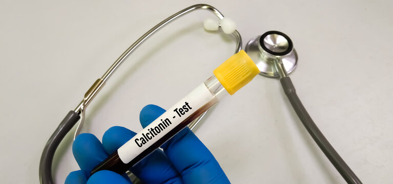 Blood sample for calcitonin hormone test. It acts to reduce blood calcium, opposing the effects of parathyroid hormone (PTH)