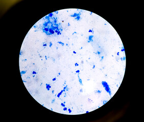 Pulmonary Tuberculosis ( TB ) : Sputum AFB stain microscopic image. To diagnosis mycobacterium tuberculosis infection. MTB mycobacterium tuberculosis  3+