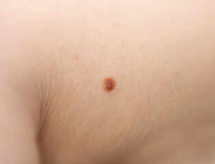 Fototapeta premium Skin mole closeup. Macro photo of blemish similar to melanoma