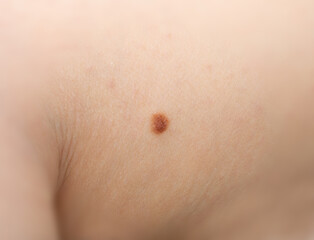 Skin mole closeup. Macro photo of blemish similar to melanoma