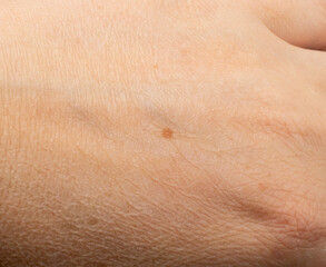 Fototapeta premium Skin mole closeup. Macro photo of blemish similar to melanoma