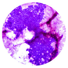 Hepatocellular dysplasia, cellular enlargement, nuclear pleomorphism, and multinucleation, light micrograph, photo under microscope