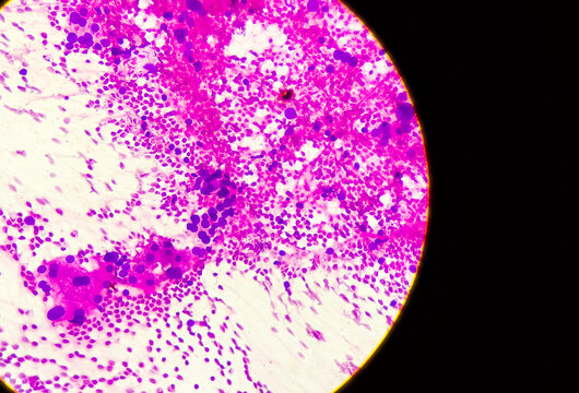 Hepatocellular Dysplasia, Cellular Enlargement, Nuclear Pleomorphism, And Multinucleation, Light Micrograph, Photo Under Microscope