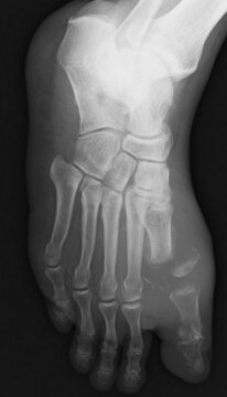 x ray image of osteomyelitis pedis
