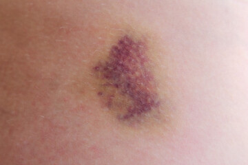 Large bruise on the human body, close up