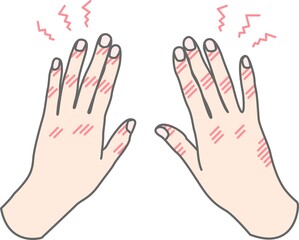 手荒れ しもやけ のイラスト