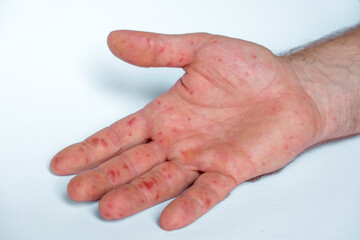 Painful rash, red spots blisters on the hand. Close up Allergy rash, human hands with dermatitis and Health problem. Ill eczema skin of patient. Viral Diseases. Red rashes on the palm. Enterovirus - obrazy, fototapety, plakaty