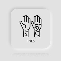 Hives on hand thin line icon. Allergy symptom. Modern vector illustration of allergic reaction.