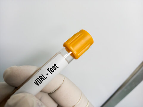 Blood samples for VDRL(venereal disease research laboratory) test in the test tube vector, screening test for syphilis